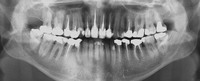 Панорамний знімок зубів (ортопантомограмма)