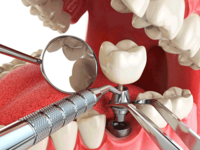 Зубні імпланти та "Імплантація зубів під ключ" у Дніпрі