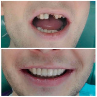 Якісне протезування зубів у місті Черкаси - безметалова кераміка